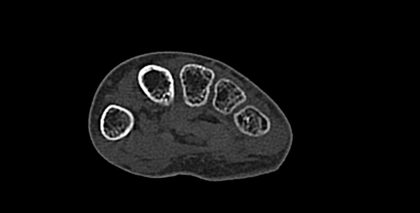 Calcifying aponeurotic fibroma (Radiopaedia 88423-105064 Axial bone window 133).jpg