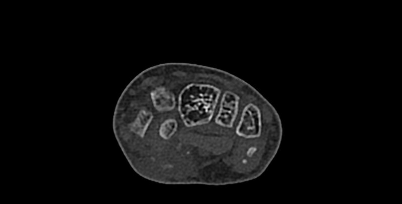 File:Calcifying aponeurotic fibroma (Radiopaedia 88423-105064 Axial bone window 80).jpg