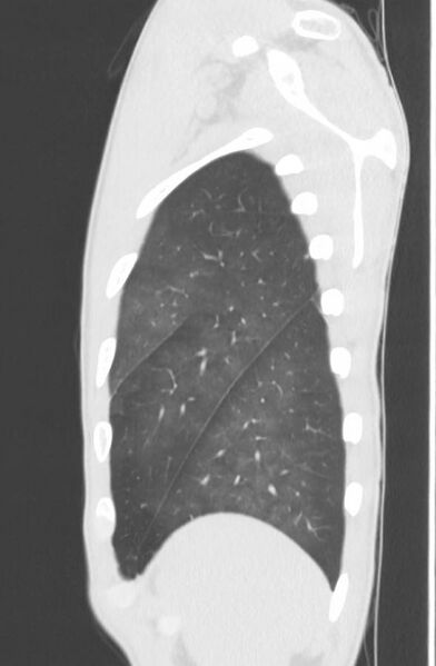 File:Cannabis-induced diffuse alveolar hemorrhage (Radiopaedia 89834-106946 Sagittal lung window 124).jpg