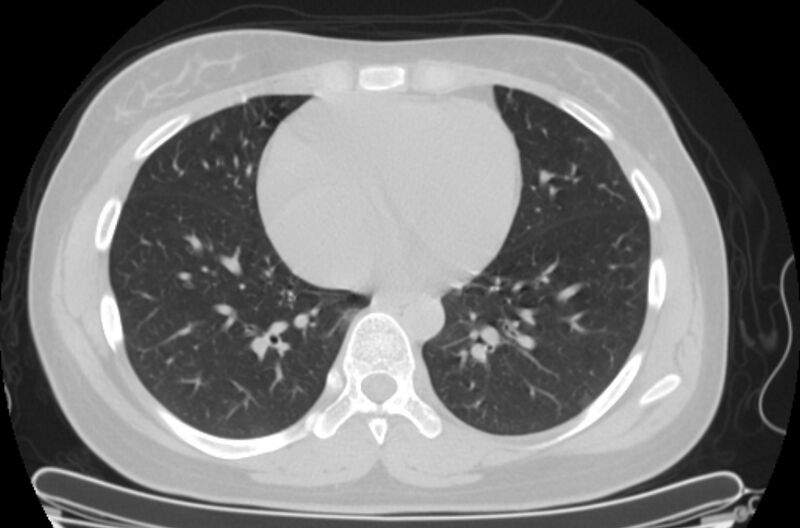 File:Cannonball metastases - uterine choriocarcinoma (Radiopaedia 70137-80173 Axial lung window 71).jpg