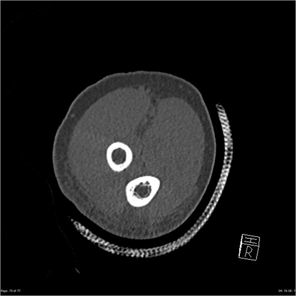 File:Capitellum fracture (Radiopaedia 23352-23426 Coronal bone window 75).jpg