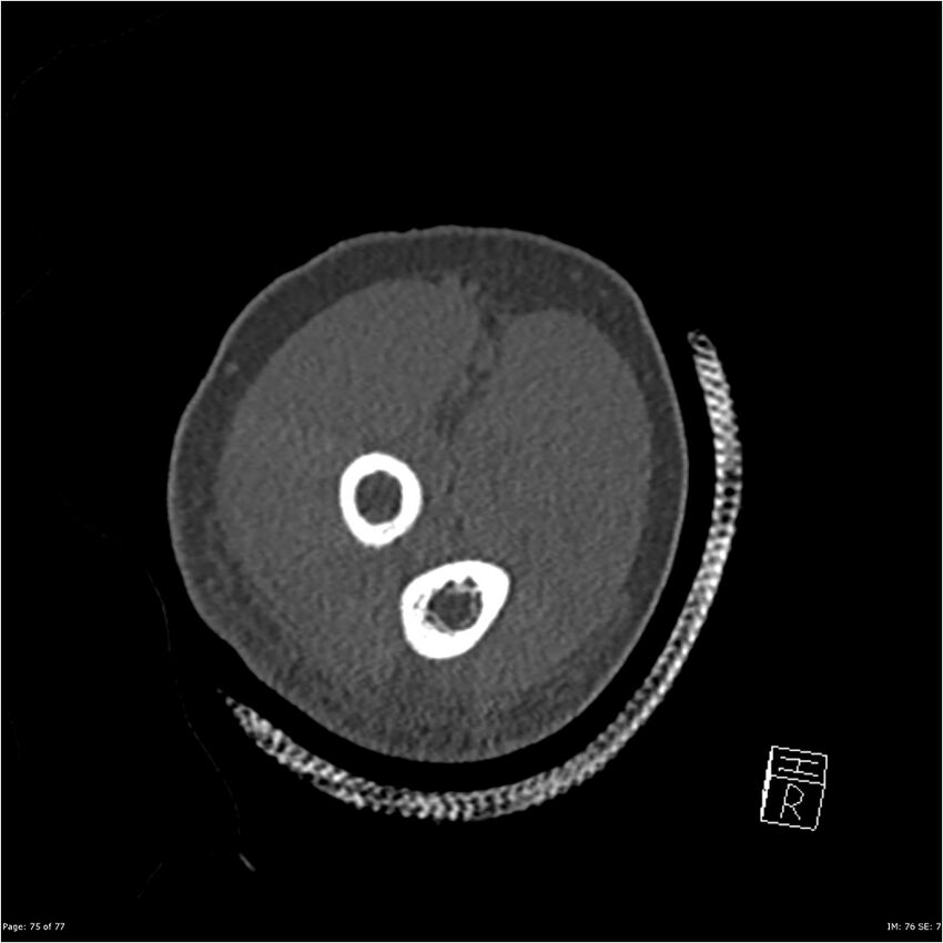 Capitellum fracture (Radiopaedia 23352-23426 Coronal bone window 75).jpg