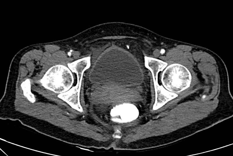 File:Carcinoid mesenteric tumor complicated by chylous ascites (Radiopaedia 76312-88926 A 74).jpg