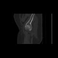 Carcinoma cervix- brachytherapy applicator (Radiopaedia 33135-34173 Sagittal bone window 12).jpg