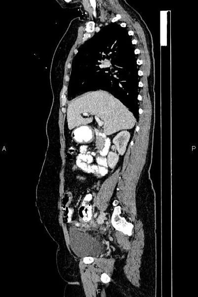 File:Carcinoma of uterine cervix (Radiopaedia 85861-101700 D 28).jpg