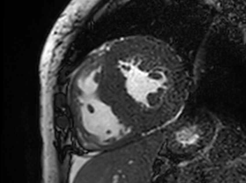 Cardiac amyloidosis (Radiopaedia 61600-69579 Short axis bSSFP 152).jpg