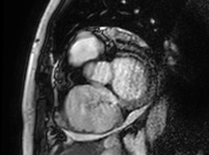 File:Cardiac amyloidosis (Radiopaedia 61600-69579 Short axis bSSFP 305).jpg