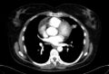 Cardiac sarcoidosis (Radiopaedia 74548-85534 A 46).jpg