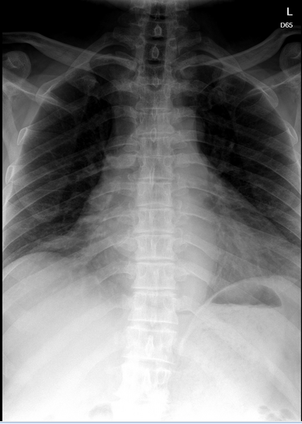File:Cardiomegaly with left atrium enlargement (Radiopaedia 84873-102142 Frontal 1).PNG
