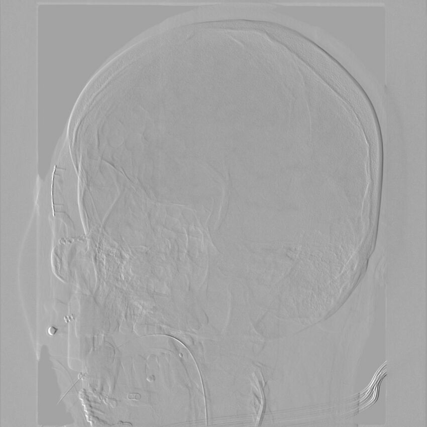 Caroticocavernous fistula - direct (Radiopaedia 61660-69666 Oblique Left ICA 45).jpg