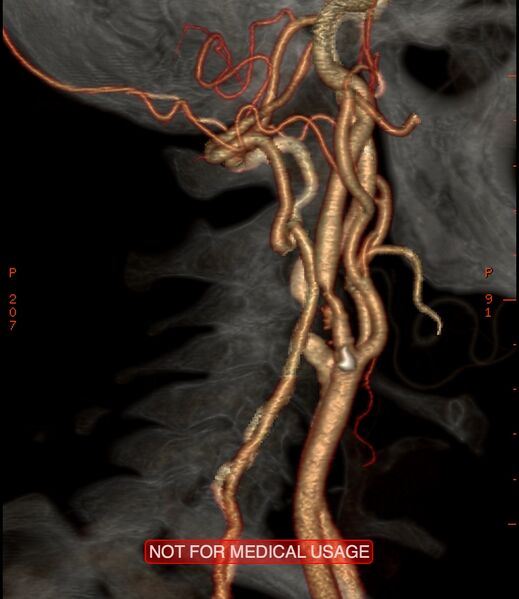File:Carotid artery stenosis (Radiopaedia 28786-29086 A 11).jpg