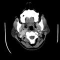 Carotid body tumor (Radiopaedia 27890-28124 A 9).jpg