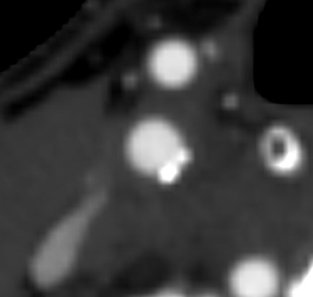File:Carotid near-occlusion (Radiopaedia 85304-100887 M 53).jpg