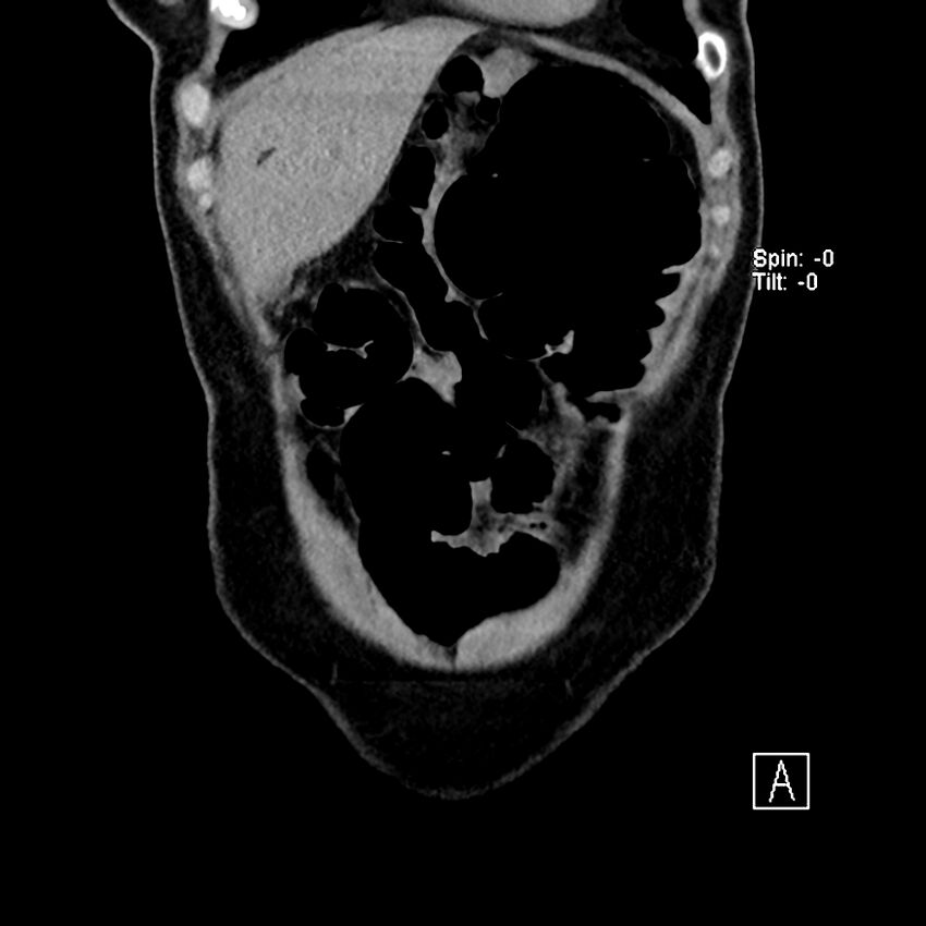 Cecal volvulus (Radiopaedia 90897-108397 Coronal non-contrast 50).jpg