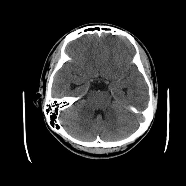 File:Central neurocytoma (Radiopaedia 79320-92379 Axial non-contrast 16).jpg
