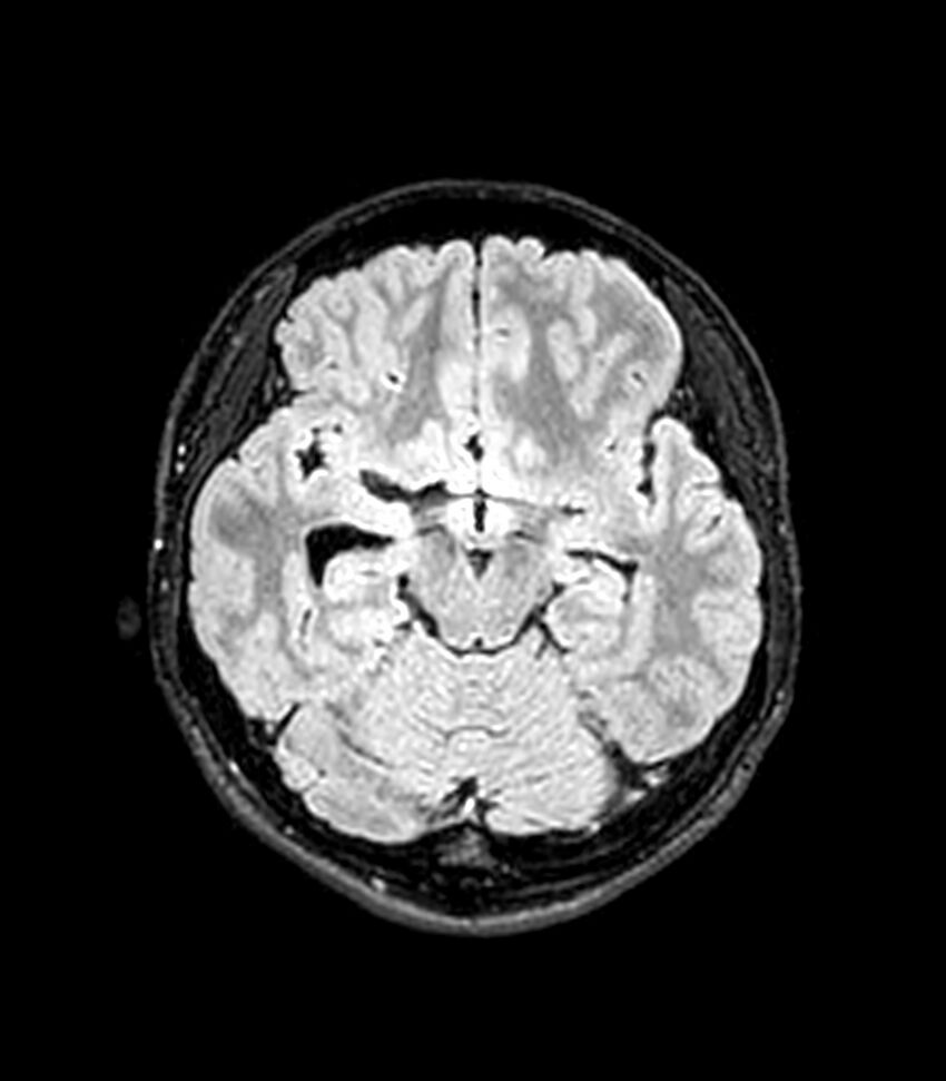 Central neurocytoma (Radiopaedia 79320-92380 Axial FLAIR 192).jpg