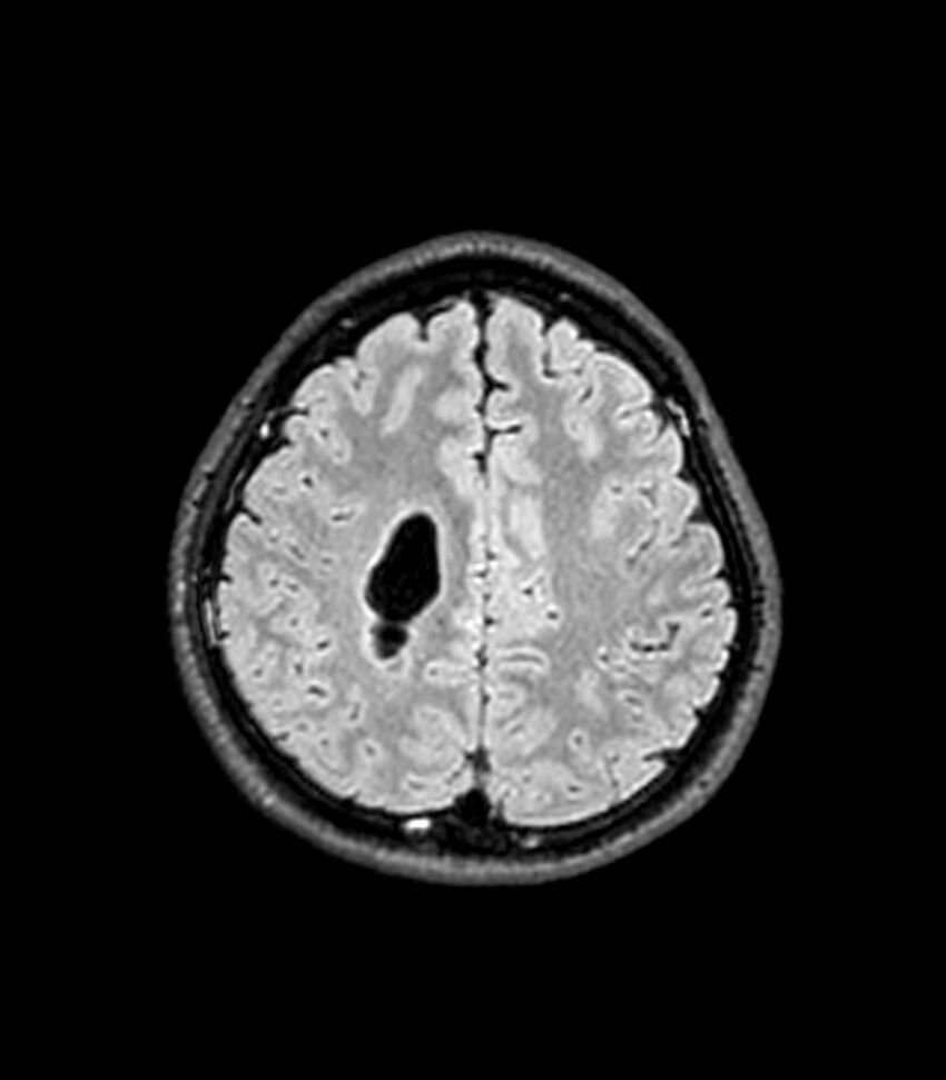 Central neurocytoma (Radiopaedia 79320-92380 Axial FLAIR 90).jpg