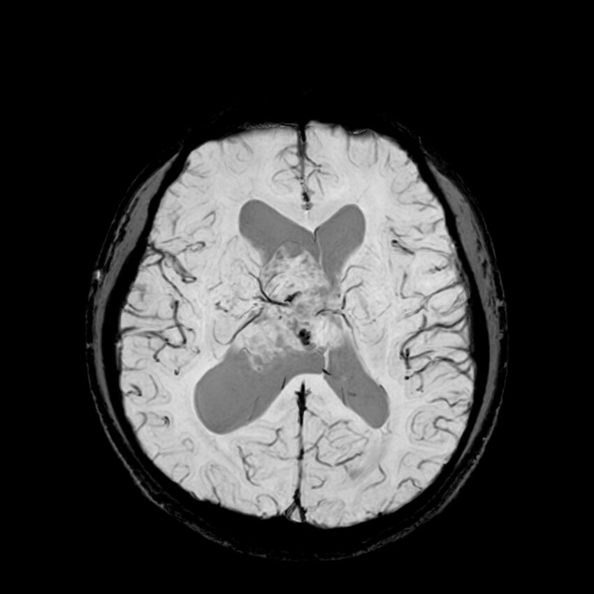 Central neurocytoma (Radiopaedia 79320-92380 Axial SWI 78).jpg