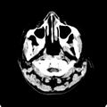 Cerebellar abscess secondary to mastoiditis (Radiopaedia 26284-26412 Axial non-contrast 1).jpg