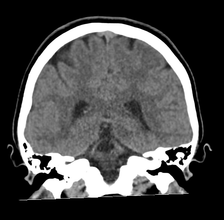 Cerebellar agenesis (Radiopaedia 30203-30817 Coronal non-contrast 27).jpg