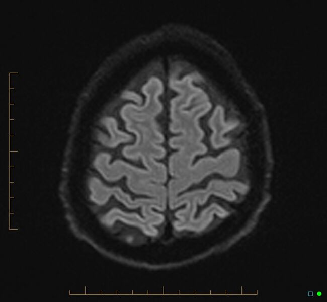 File:Cerebellar gangliocytoma (Radiopaedia 65377-74422 Axial DWI 34).jpg