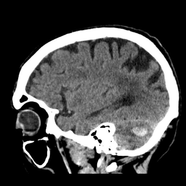 File:Cerebellar hemorrhage (Radiopaedia 27193-27359 C 33).jpg