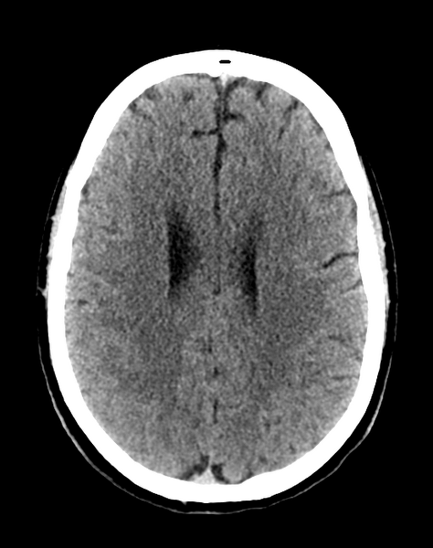 File:Cerebellar infarct due to vertebral artery dissection with posterior fossa decompression (Radiopaedia 82779-97033 Axial non-contrast 24).png