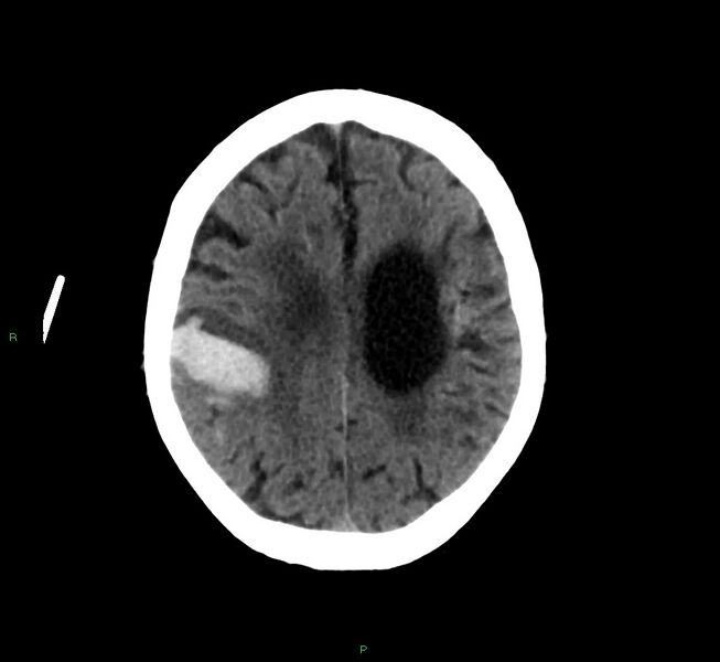 File:Cerebral amyloid angiopathy-associated lobar intracerebral hemorrhage (Radiopaedia 58376-65513 Axial non-contrast 17).jpg