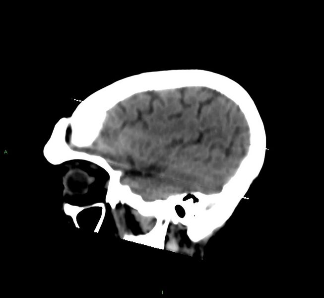 File:Cerebral amyloid angiopathy-associated lobar intracerebral hemorrhage (Radiopaedia 58377-65514 B 41).jpg