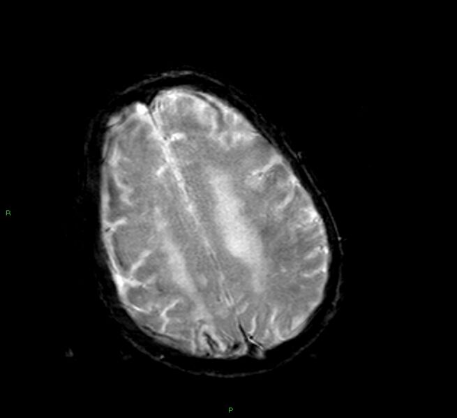 File:Cerebral amyloid angiopathy-associated lobar intracerebral hemorrhage (Radiopaedia 58377-65515 Axial Gradient Echo 9).jpg
