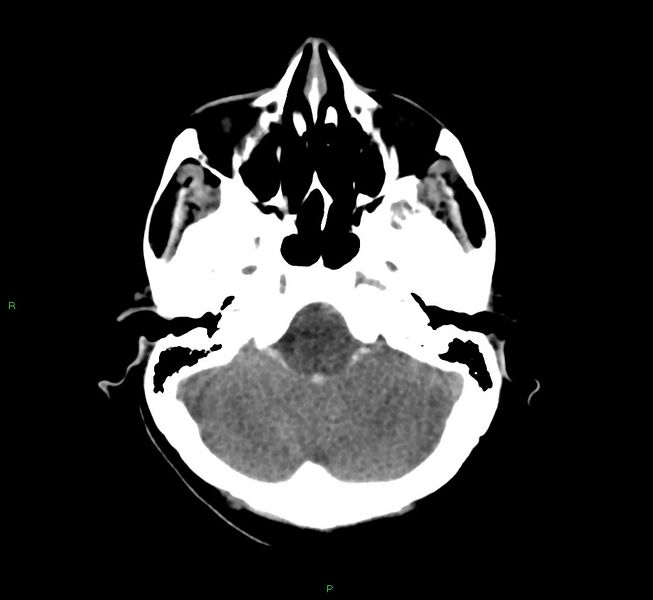 File:Cerebral amyloid angiopathy-associated lobar intracerebral hemorrhage (Radiopaedia 58566-65730 Axial non-contrast 41).jpg