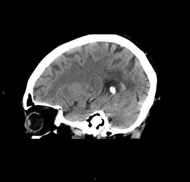 File:Cerebral amyloid angiopathy-associated lobar intracerebral hemorrhage (Radiopaedia 59356-66716 C 38).jpg