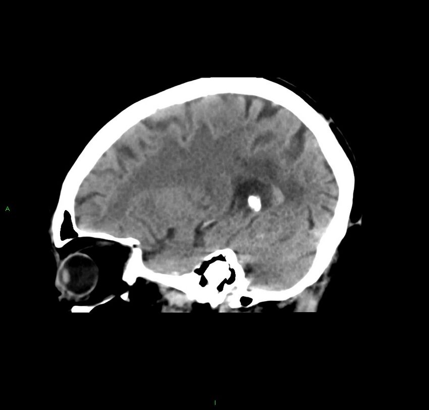 Cerebral amyloid angiopathy-associated lobar intracerebral hemorrhage (Radiopaedia 59356-66716 C 38).jpg
