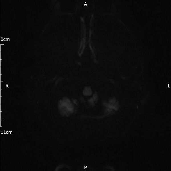 File:Cerebral amyloid angiopathy related inflammation (Radiopaedia 72772-83415 Axial DWI 49).jpg