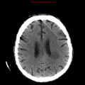 Cerebral and orbital tuberculomas (Radiopaedia 13308-13310 Axial non-contrast 19).jpg