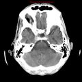 Cerebral and orbital tuberculomas (Radiopaedia 13308-13310 B 9).jpg