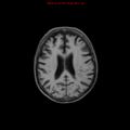 Cerebral and orbital tuberculomas (Radiopaedia 13308-13311 Axial T1 14).jpg