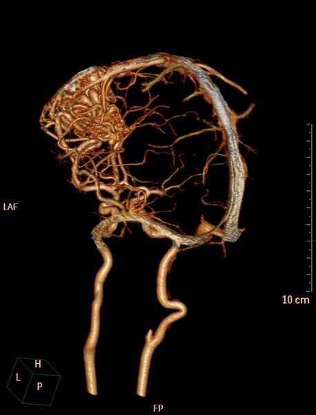 File:Cerebral arteriovenous malformation (Radiopaedia 29531-30031 B 13).jpg