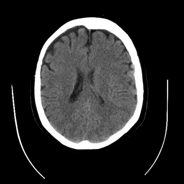 File:Cerebral arteriovenous malformation (Radiopaedia 43729-47189 Axial non-contrast 25).jpg