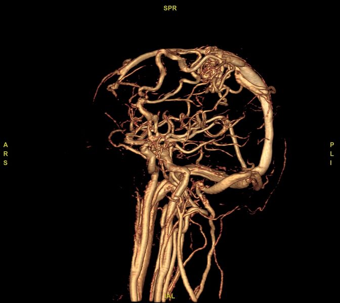 File:Cerebral arteriovenous malformation (Radiopaedia 61964-70029 VRT 49).jpg