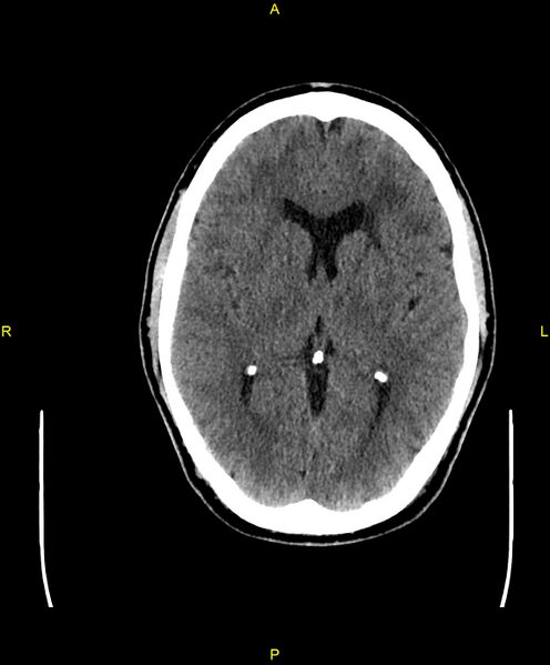 File:Cerebral autosomal dominant arteriopathy with subcortical infarcts and leukoencephalopathy (CADASIL) (Radiopaedia 86108-102051 Axial non-contrast 55).jpg