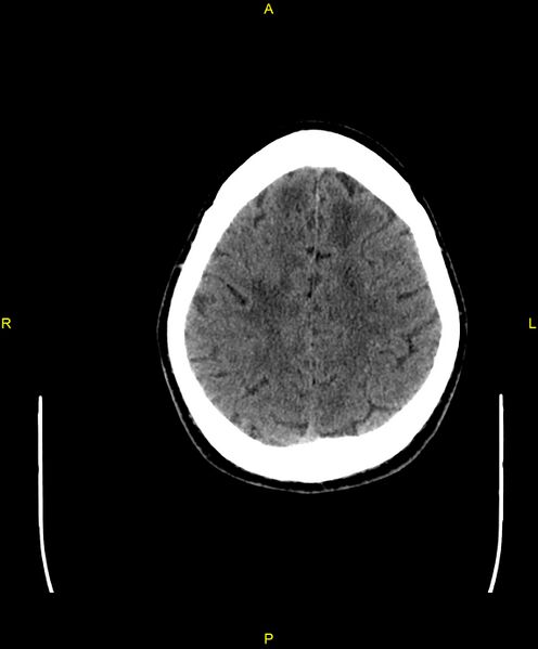 File:Cerebral autosomal dominant arteriopathy with subcortical infarcts and leukoencephalopathy (CADASIL) (Radiopaedia 86108-102051 Axial non-contrast 89).jpg