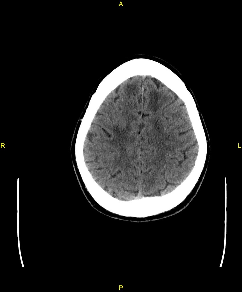Cerebral autosomal dominant arteriopathy with subcortical infarcts and leukoencephalopathy (CADASIL) (Radiopaedia 86108-102051 Axial non-contrast 89).jpg