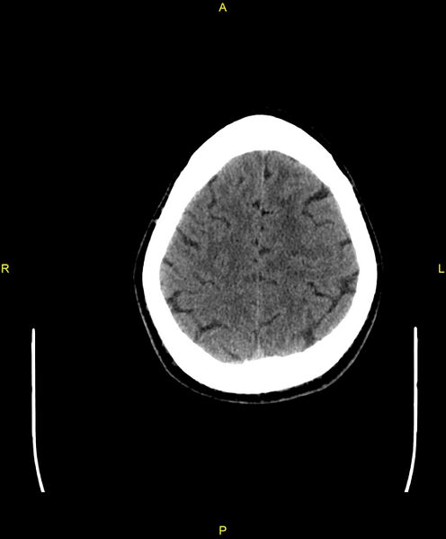 File:Cerebral autosomal dominant arteriopathy with subcortical infarcts and leukoencephalopathy (CADASIL) (Radiopaedia 86108-102051 Axial non-contrast 93).jpg