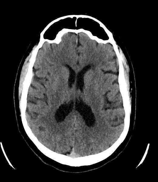 File:Cerebral dural venous sinus thrombosis (Radiopaedia 86514-102575 Axial non-contrast 25).jpg