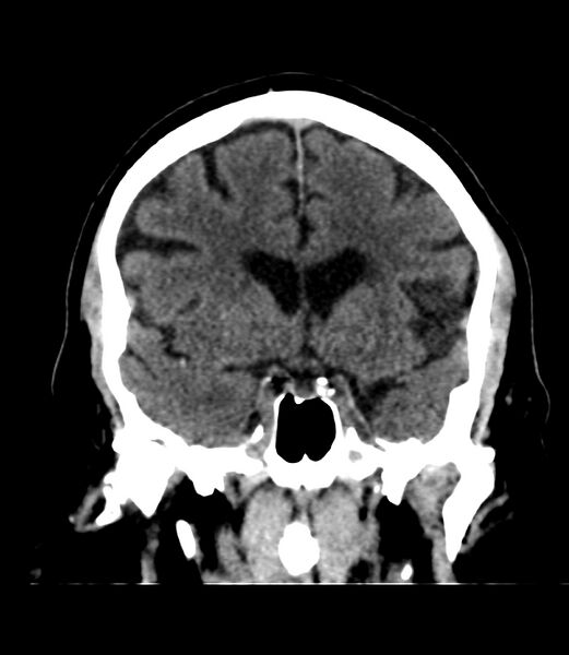 File:Cerebral dural venous sinus thrombosis (Radiopaedia 86514-102575 Coronal non-contrast 18).jpg