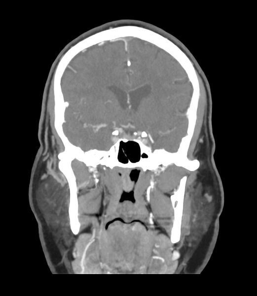 File:Cerebral dural venous sinus thrombosis (Radiopaedia 86514-102576 B 25).jpg