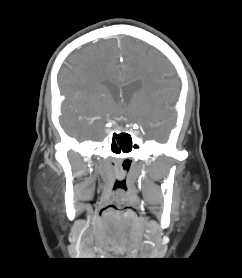 Cerebral dural venous sinus thrombosis (Radiopaedia 86514-102576 B 25).jpg