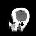 Cerebral hemorrhagic contusions (Radiopaedia 23145-23188 C 6).jpg