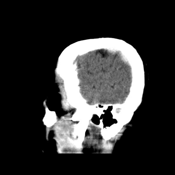 File:Cerebral hemorrhagic contusions (Radiopaedia 23145-23188 C 6).jpg